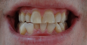 DentoAmerica_Dentist_Cleaning_Whitening_BEFORE